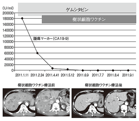 樹状細胞ワクチン療法の効果