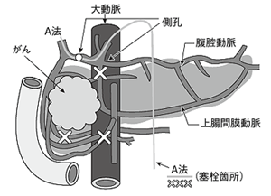 膵臓をめぐる血管の様子と平山式血流改変術