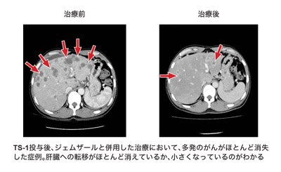 図：TS-1先行＋ジェムザールが効いた症例