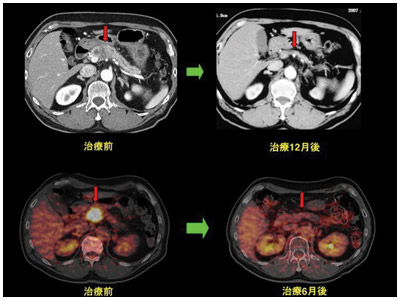 図：重粒子線によって膵がんが消失した例