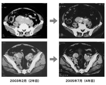 CT写真左：2003年2月（2年目）　右：2005年7月（4年目）