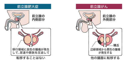 図：前立腺がんと前立腺肥大症の違い