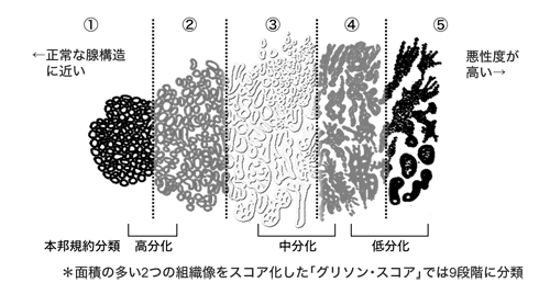 図:グリソン分類