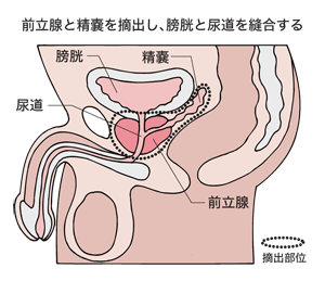 図:前立腺全摘除術の方法
