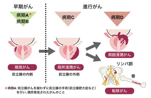 図：前立腺がんの進み方