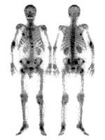 骨シンチグラムで見る骨転移の様子