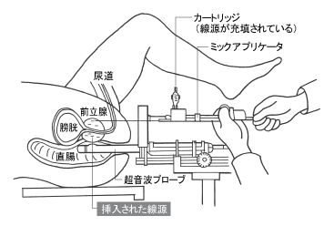 密封小線源の前立腺への埋め込み方