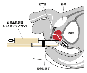 図3　バイオプティガンを用いて行う針生検の方法