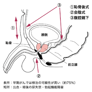 図6　前立腺がんの手術方法