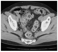 骨盤部CT：MAB療法施行6ヵ月後