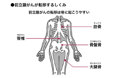 図：転移しやすい骨の部位