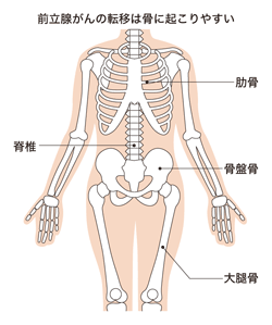 図:PSA前立腺がんが転移しやすい骨の部位