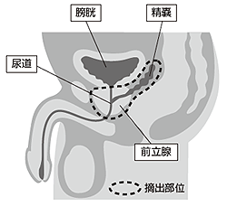 前立腺全摘除術の仕組み