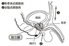 開腹手術
