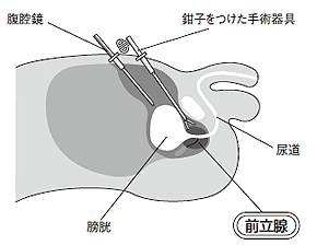 腹腔鏡手術
