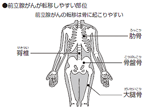 骨転移への治療法は?