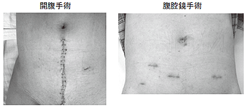 写真5 開腹手術と腹腔鏡手術のメスの入れ方の違い
