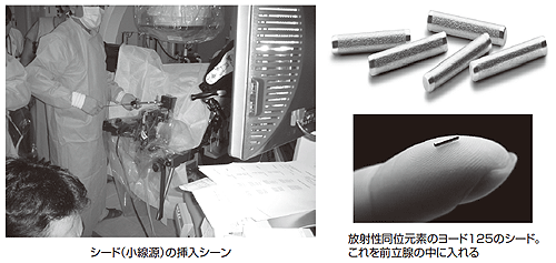 写真6 小線源療法の方法