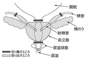 図4 前立腺全摘除術での摘除部