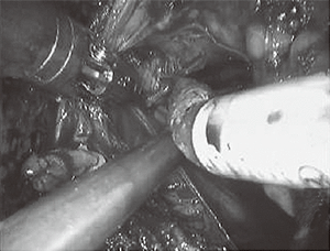 図5 ロボット手術による前立腺全摘除術の様子