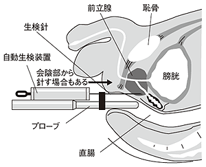 図3 前立腺がんの生検