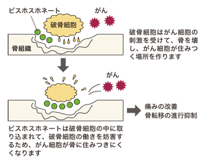 図:骨転移の進行を抑えるビスホスホネートの治療法