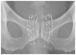 前立腺内に挿入されたヨウ素125シード線源のX線写真
