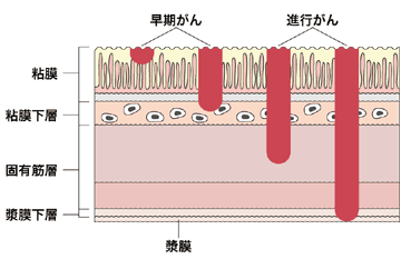 図：大腸がんの病期