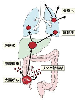 図：大腸がんの転移