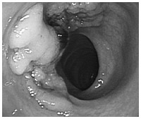 大腸内視鏡で見た早期の大腸がん