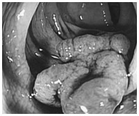 大腸内視鏡で見た早早期の大腸ポリープがん