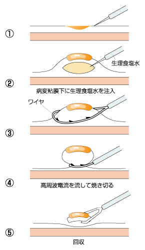 図：内視鏡的粘膜切除術（EMR）の手順