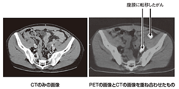 PET-CTによる腹膜播種の診断