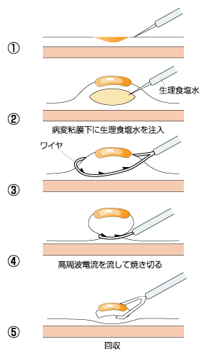 内視鏡的粘膜切除術の手順