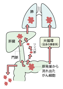 大腸がんの転移のメカニズム