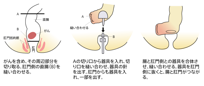 肛門括約筋温存術