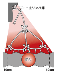 図:結腸切除術(D3郭清)