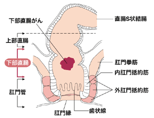 図：下部直腸がんとは