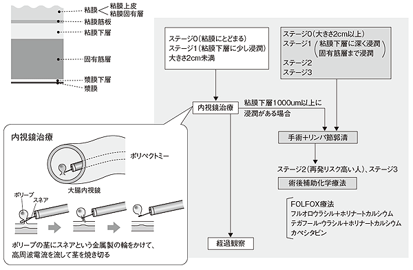 ステージ0～3の治療方針