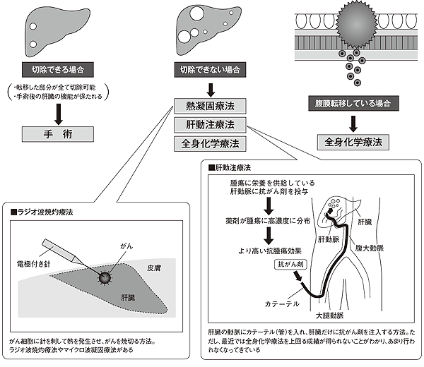肝転移