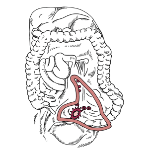 図：大腸がんの手術の基本