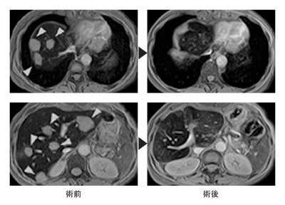 図：大腸がん肝転移のMRI