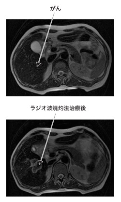 大腸がんが転移した肝臓のMRI画像