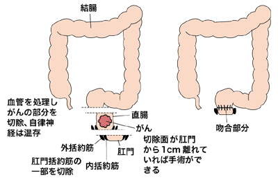 図：超低位前方切除術