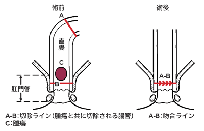 図：肛門温存療法