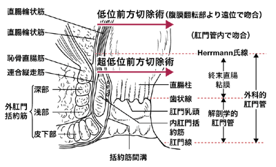 図：下部直腸がんの切除術