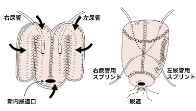 図：回腸を使って代用膀胱をつくる回腸パウチ術