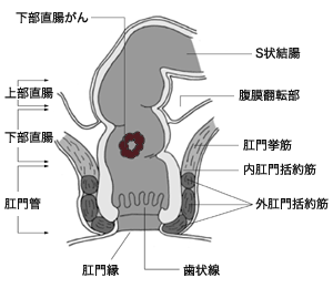 図：下部直腸がんの位置
