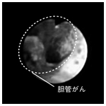 胆道鏡検査/胆管内のあちこちにがんができているのが見られる