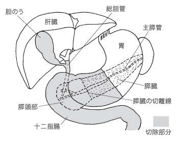 膵頭十二指腸切除術